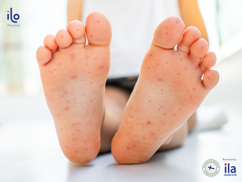 Trẻ bị tay chân miệng có lây cho người lớn? Cách phòng tránh